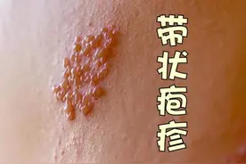 一个厉害的方子，消肿祛湿，败毒祛痰，化解湿疹，带状疱疹。图片