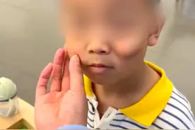 6岁男童不小心磕伤脸长一道沟，害怕别人眼光不敢笑，妈妈：没有好的治疗办法，医生说长大了一笑就有沟图片