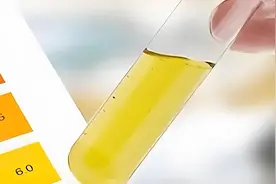 尿液检查中蛋白质、葡萄糖和酮体异常升高，当心这几个潜在疾病图片
