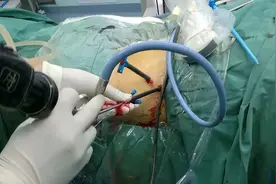 前列腺手术后尿失禁处理方法图片