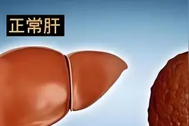 精氨酸谷氨酸或助逆转脂肪肝，专家提醒：运动与减脂才是真正关键图片