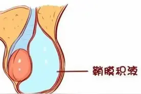 一分钟全面认识小儿鞘膜积液图片