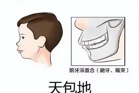 牙齿天包地正常吗？图片
