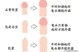 发现孩子包皮过长怎么办？答案就在这篇图片