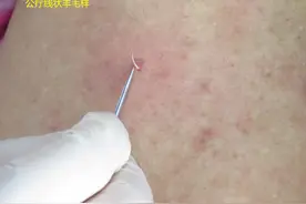 记住！挑羊毛疔不是经络环皮部挑治法，千万别搞错了图片