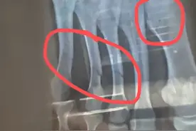 男子健身房失误砸断女生4根脚趾？教练：这种失误在健身房经常发生…图片