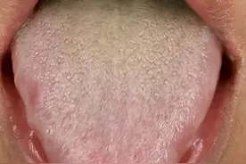 肝是哑巴脏，但舌头上早有征兆，这4种舌相，提示你肝快出问题了图片