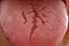 舌上一裂纹，肾中一缕火，一个古方滋阴降火，帮你抹平裂纹舌图片