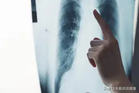 35岁肺癌晚期，抽出12升胸腔积液，做了6期化疗，肿瘤缩小了图片