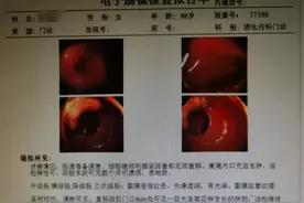 病例2则：直肠癌患者的福音——腹腔镜下低位直肠癌（保肛）根治术图片