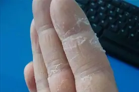 手指脱皮是因为皮肤干燥？医生：别大意！或是这两种疾病的信号图片