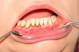 患有牙周炎，牙齿最终都会掉光吗？图片