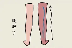 一条腿肿可能是这些问题图片