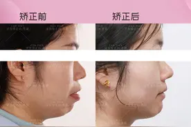 成年人能做牙齿矫正吗？成年人嘴凸矫正有效果吗？图片