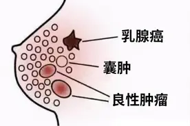 乳腺结节出现六大指征要当心，该怎么应对？图片