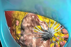 肉芽肿病程最顶峰，一个方法，两步结合，立即消除痛苦图片