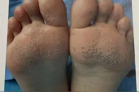 窝状角质松解症：“脚底长有密密麻麻的小坑”图片