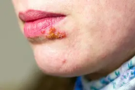 唇疱疹有什么好的处理方式吗？图片