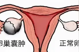 突然发现肚子变大？小心是卵巢囊肿在作怪！图片