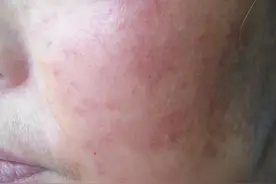 4个中成药，袪风止痒有良效，远离荨麻疹、湿疹、皮炎等皮肤病图片