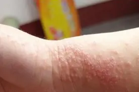 有一种痒，叫湿疹！皮肤瘙痒难耐，一个中成药可止图片