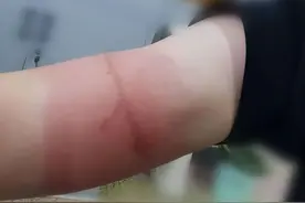 警惕！男子身上惊现16cm“长线”！暂无特效药，严重可致命图片