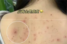 后背痘痘过来人分享自愈经验！这个思路值得学习！图片