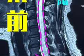 别再拖了！要想术后效果好，这种脊髓空洞症患者一定要趁早！图片