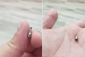 港人内地种牙，“螺丝”脱落差点噎死图片