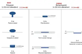 这些位置长了息肉，一定要当心！尤其这种几乎100%会癌变图片