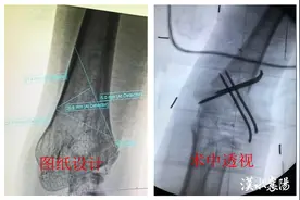 胳膊肘“往里拐”？小切口截骨矫形 守护花季美好图片
