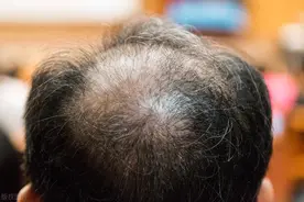 谢顶的人从哪里开始虚了？稀少的头发该如何“救活”？医生告诉你图片