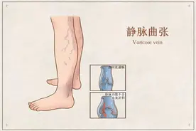 关于静脉曲张，这篇文章都说清楚了！点击收藏！图片