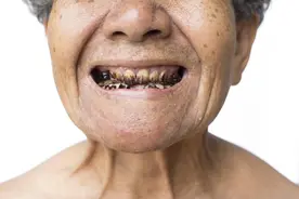 掉牙和寿命有关？60岁后，牙齿剩多少颗才正常？看看你达标了没图片