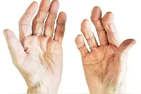 手部循环不好，早晨起来手胀僵硬，这样刮手指，舒筋活络灵活双手图片