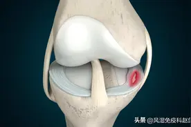 膝关节半月板损伤，多久可以恢复？该怎么治疗？图片