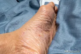 得了脚气怎么办？5种治疗脚气（足癣）的OTC类乳膏剂一定要记住。图片