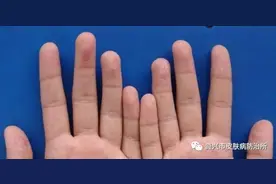 儿童手脱皮，需注意这几种疾病图片