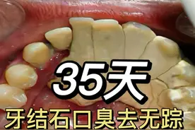 多年牙结石口臭终于解决了！学会这几招，清新口气易如反掌！图片