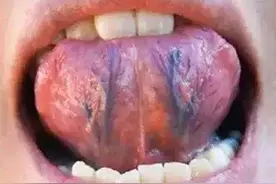 舌下青筋粗紫发黑？体内必有痰湿瘀堵，一个药，打通全身瘀堵！图片
