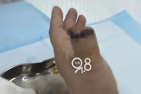 手上总有股臭咸鱼味，70岁大伯傻眼：竟是癌症！图片