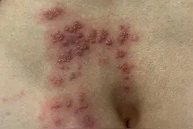 大爷紧张坏了，以为得了绝症没想到却是带状疱疹图片