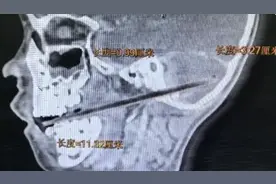 揪心，6岁男童口含麦芽糖摔倒，被竹签刺入小脑图片