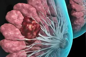 乳腺癌术后，预防复发转移，这2类患者需要做强化治疗图片