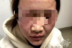 30天不洗脸皮肤会更好？杭州一男子试了一个月，脸皮变“树皮”图片