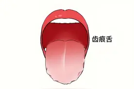 舌头齿痕有牙印？竟是这三种病症，中医教你正确分辨调理！图片