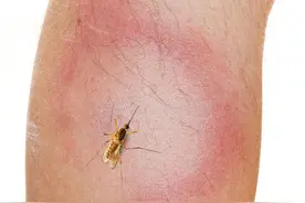 脸上有被蚊子叮个包了，要怎么去消除？图片