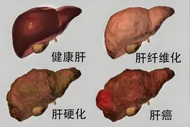 “小心肝”，肝脏对人体有哪些作用？应该知晓图片