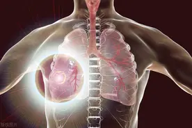 女大学老师体检发现1.2厘米肺结节，病检浸润性腺癌，预后如何图片