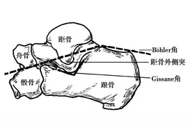 收藏 | 跟骨骨折手术入路及方式图片